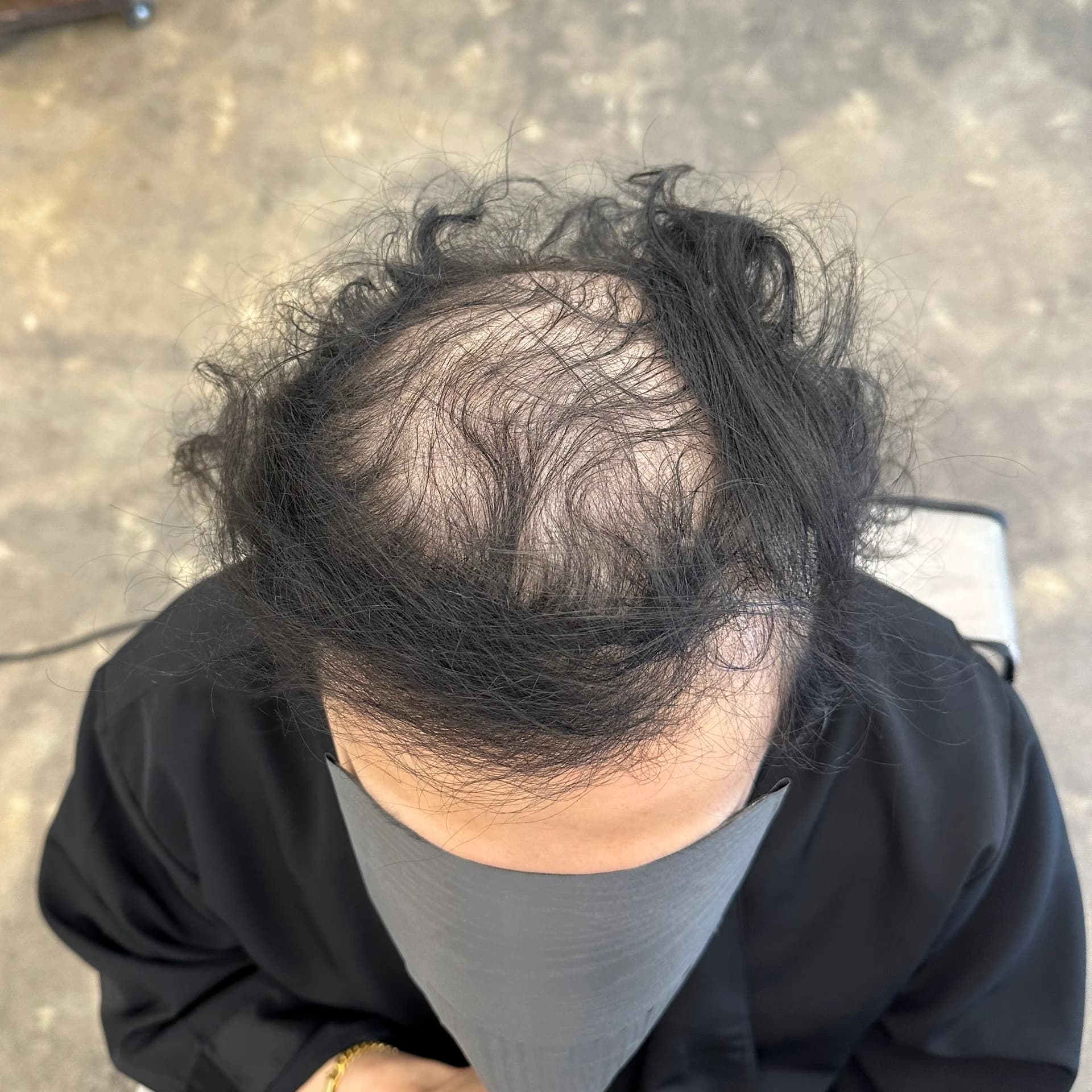 두피페인팅 (치트염색) 시술 전후 비교 - 리턴헤어