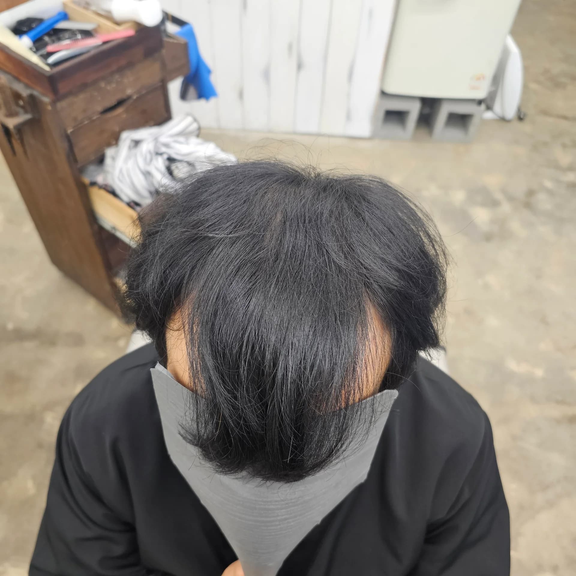 탈모 치트펌 시술 전후 비교 - 리턴헤어