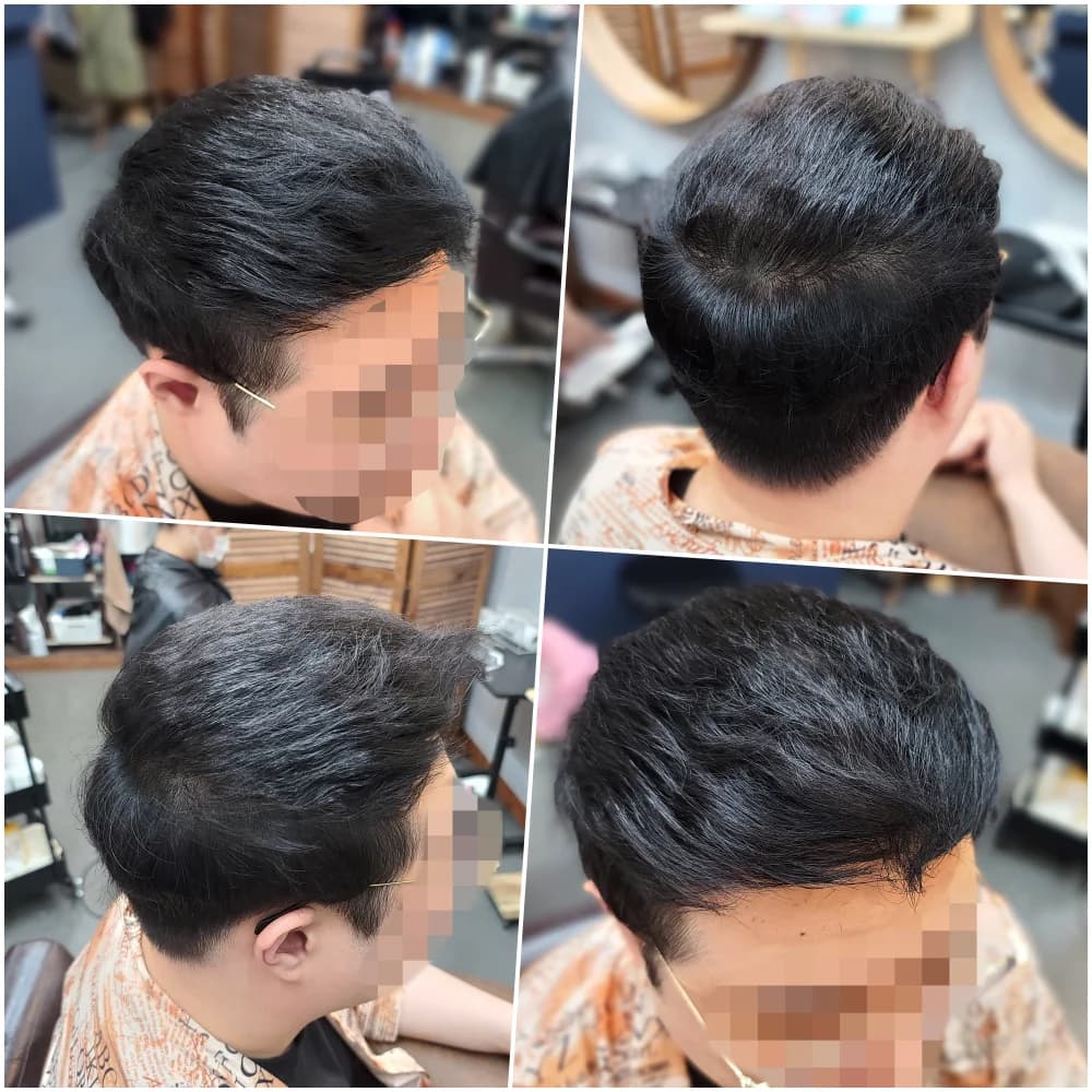 탈모 치트펌 시술 전후 비교 - 리턴헤어