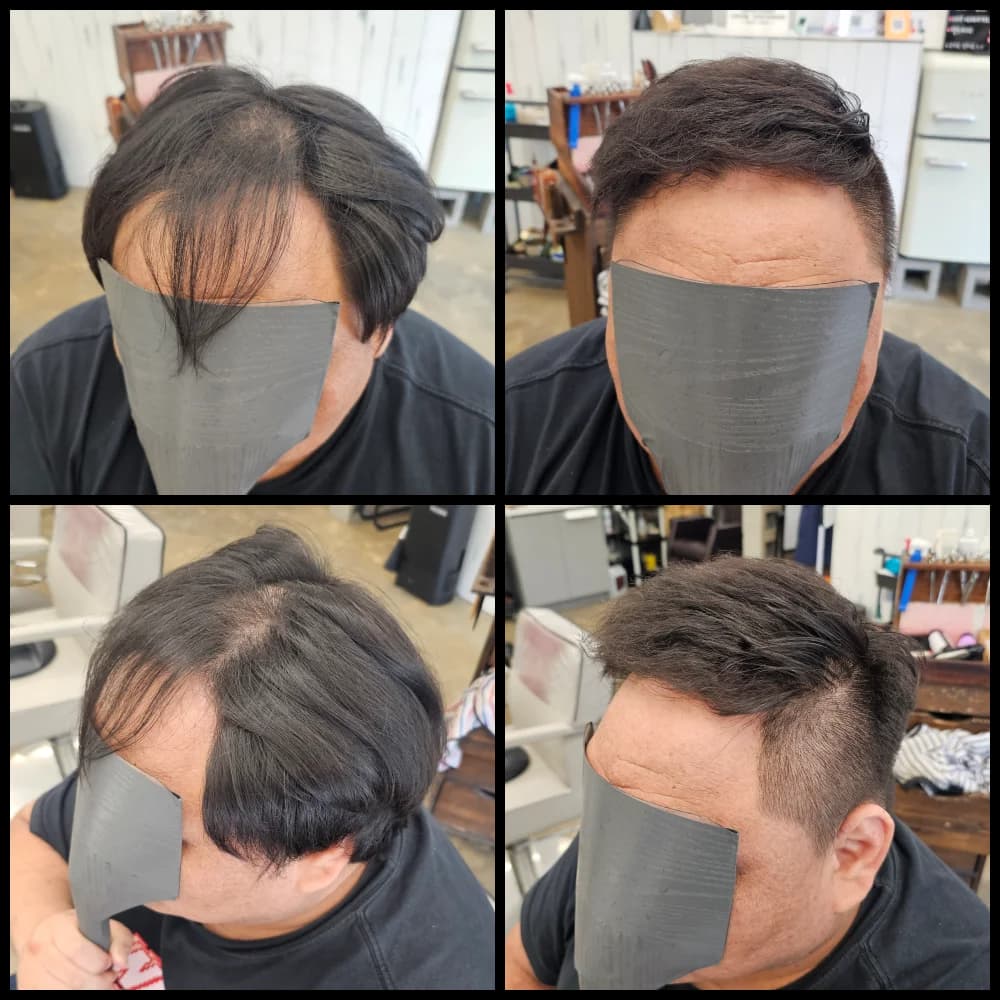 탈모 치트펌 시술 전후 비교 - 리턴헤어