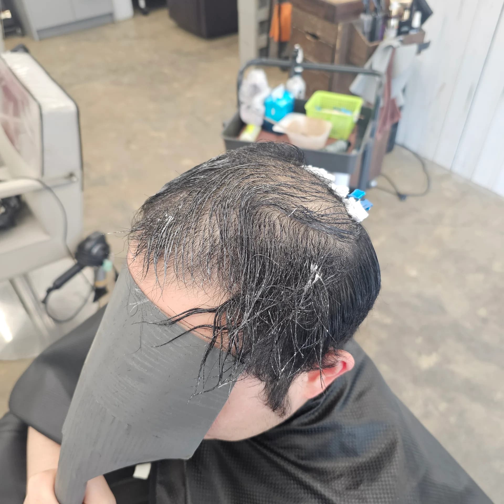 입춘 테라피 (플라즈마 PDRN) 시술 전후 비교 - 리턴헤어