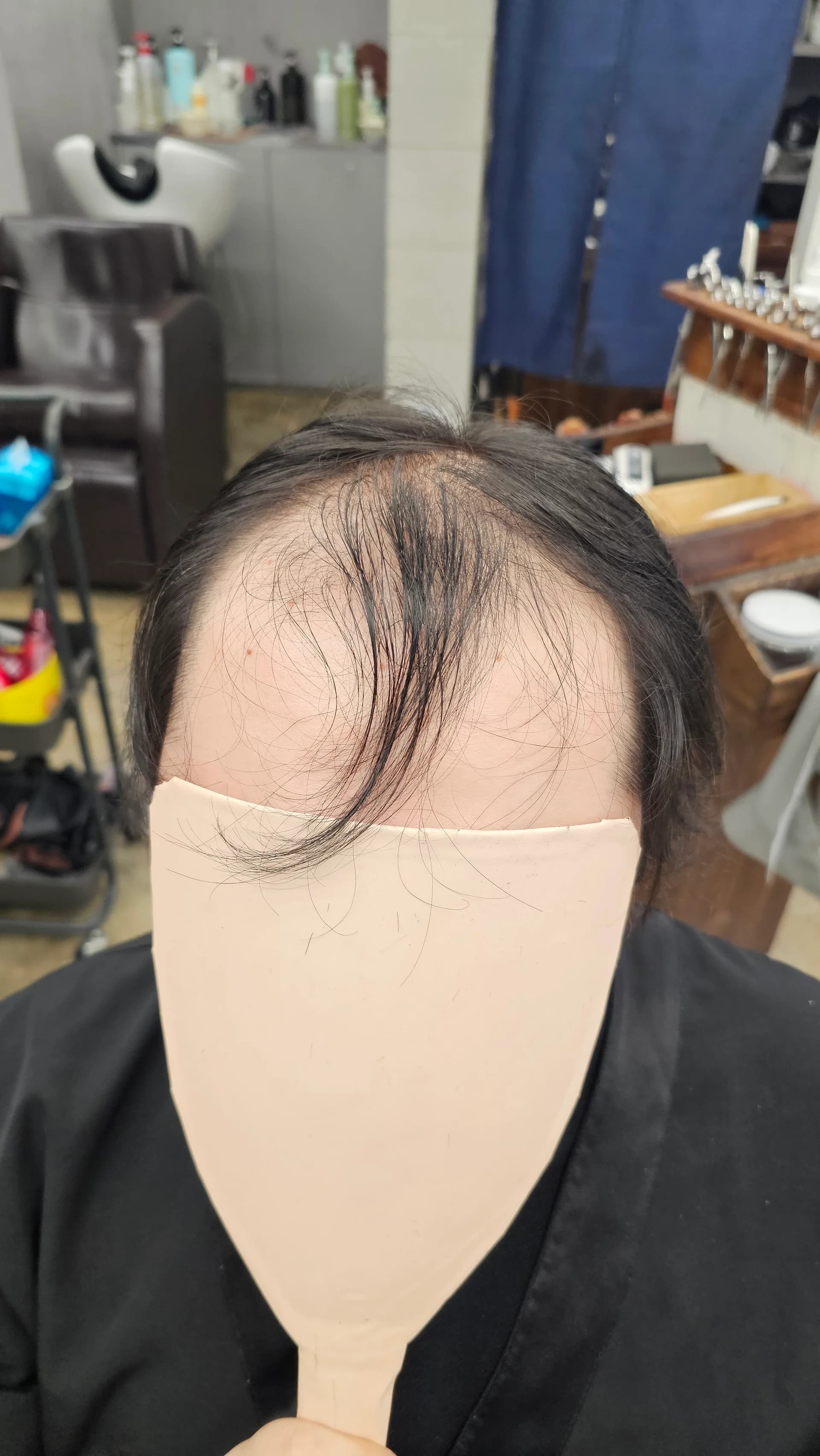 탈모 치트펌 파마 시술 전후 비교 - 리턴헤어