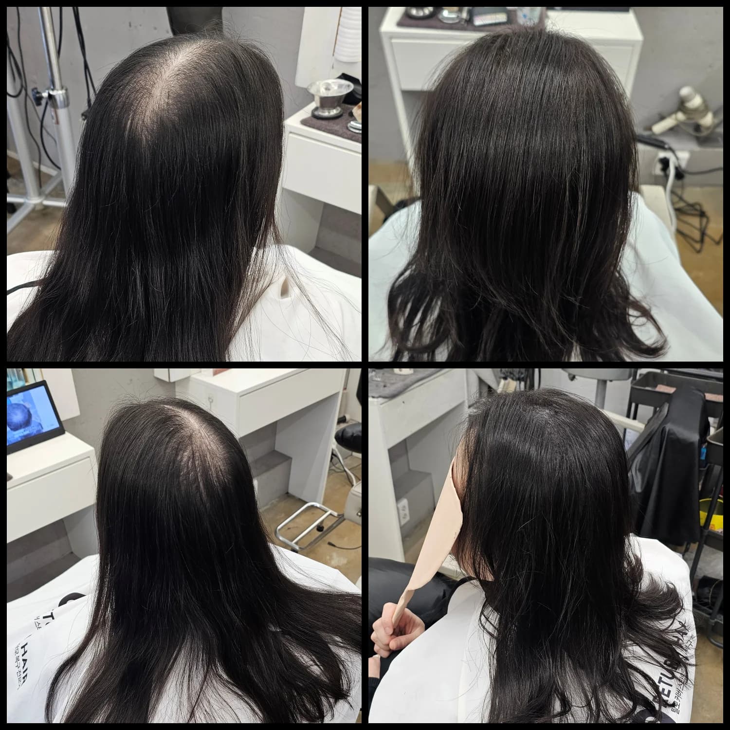 입춘 테라피 (플라즈마 PDRN) 시술 전후 비교 - 리턴헤어