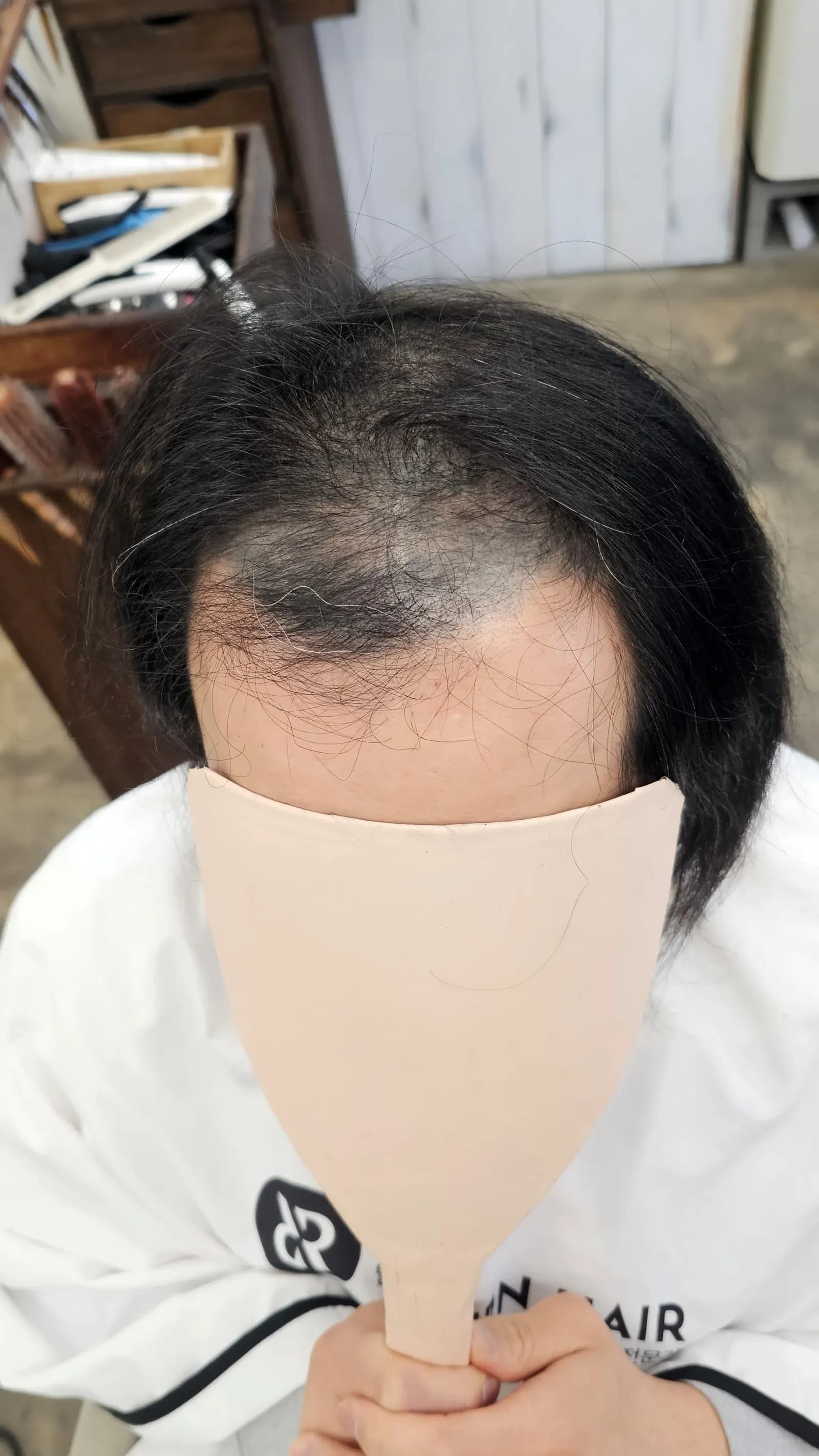 탈모 치트펌 파마 시술 전후 비교 - 리턴헤어
