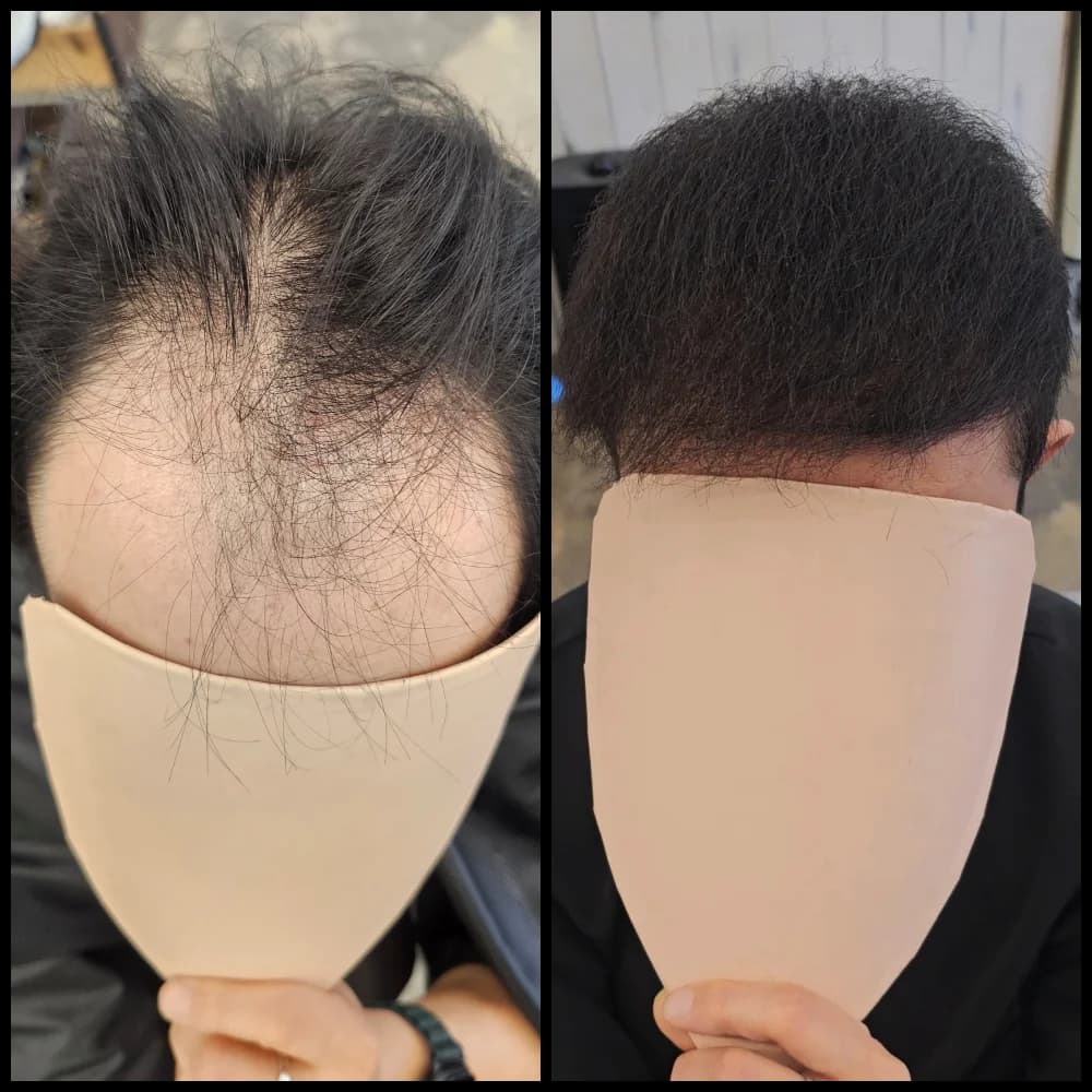 탈모 치트펌 파마 시술 전후 비교 - 리턴헤어