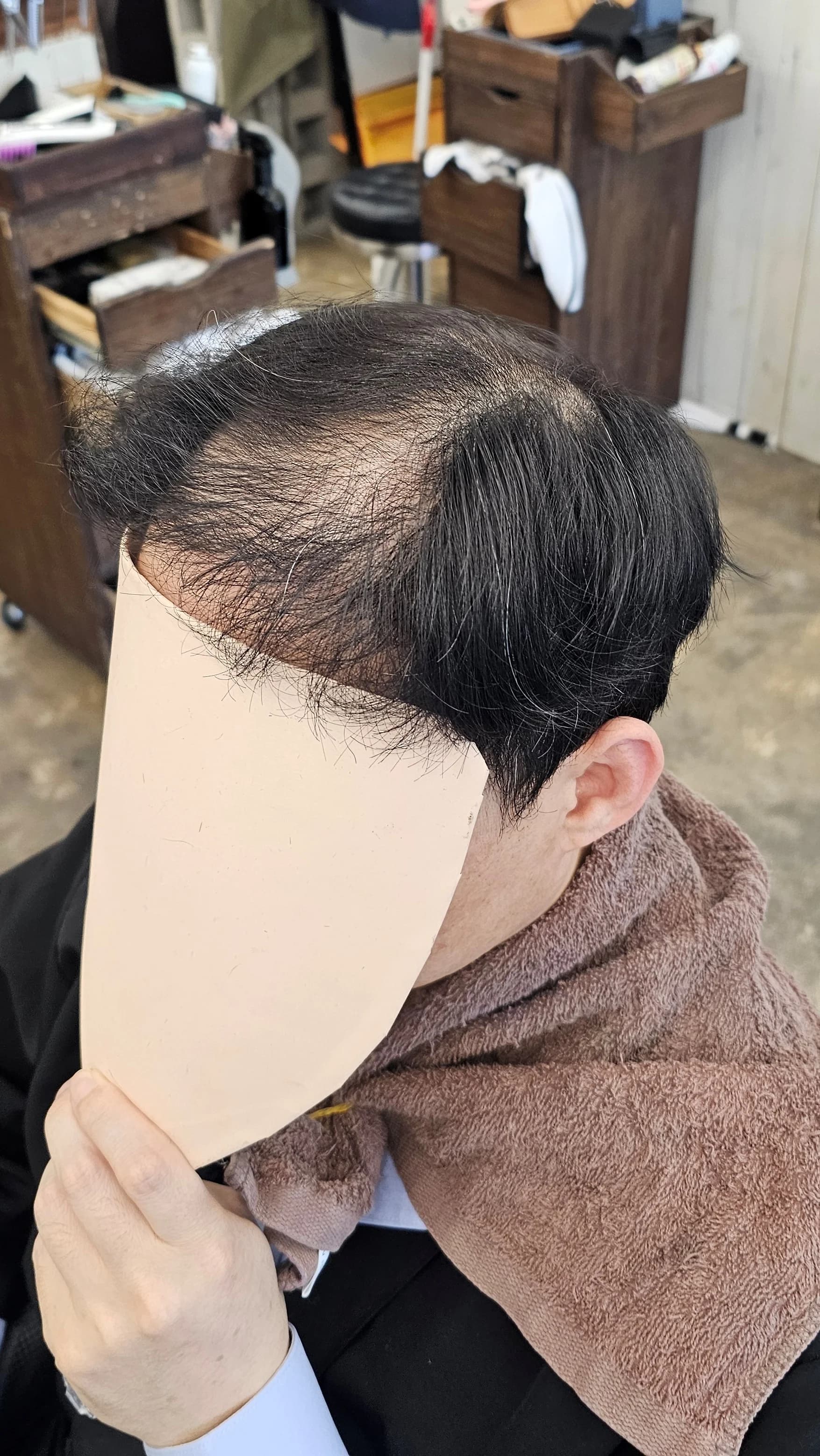 탈모 치트펌 파마 시술 전후 비교 - 리턴헤어