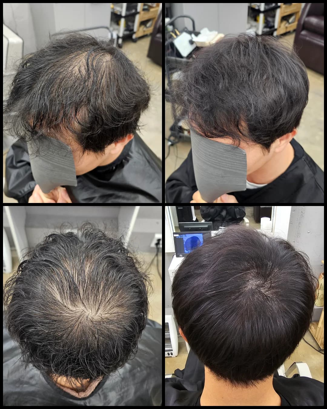 두피페인팅 (치트염색) 시술 전후 비교 - 리턴헤어